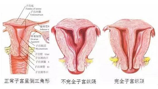 纵隔子宫