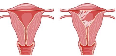 以宫腔粘连做试管能成功吗？医学视角与治疗策略