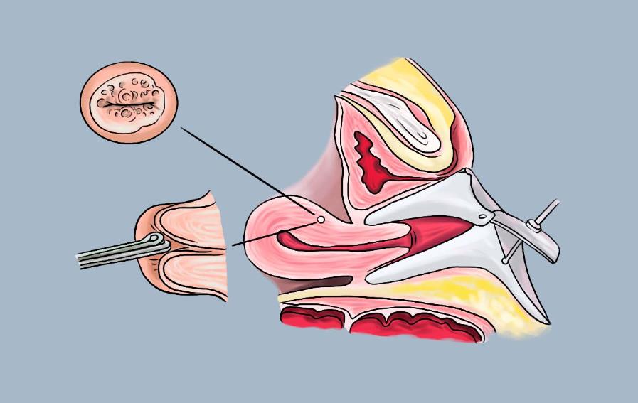 子宫内膜活检是检查什么,子宫内膜活检痛不痛