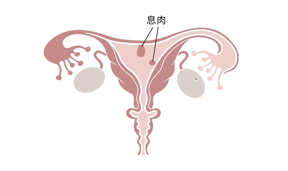 子宫内膜息肉不做手术可以做试管吗,子宫内膜息肉做试管的成功率