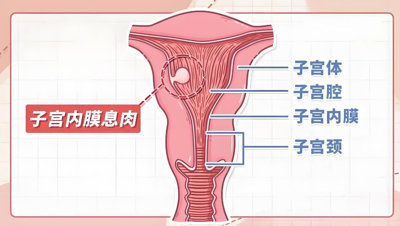 子宫内膜息肉