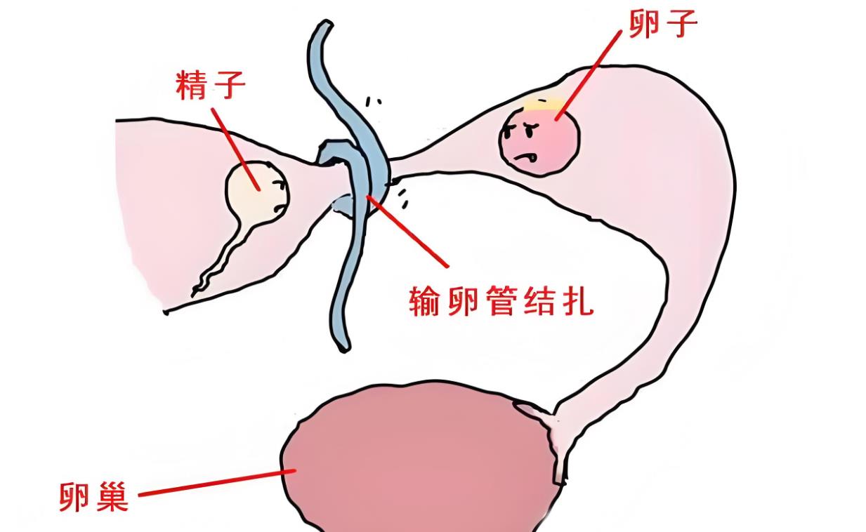 输卵管结扎示意图